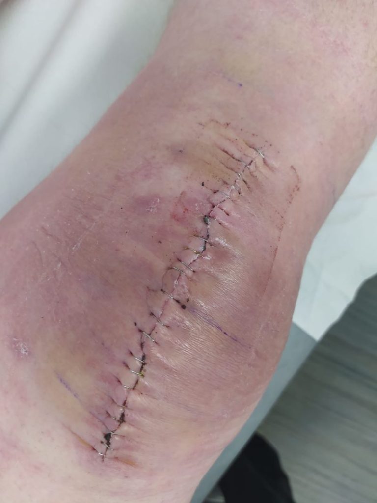 a knee following full knee replacement surgery